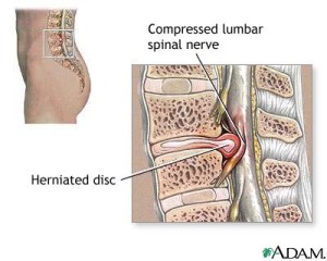 Personal Injury Lumbar Spine